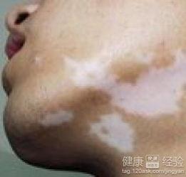 吃黑瓜治疗白癜风吗,揭秘白癜风患者的天然疗法