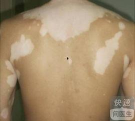 吃黑瓜治疗白癜风吗,揭秘白癜风患者的天然疗法